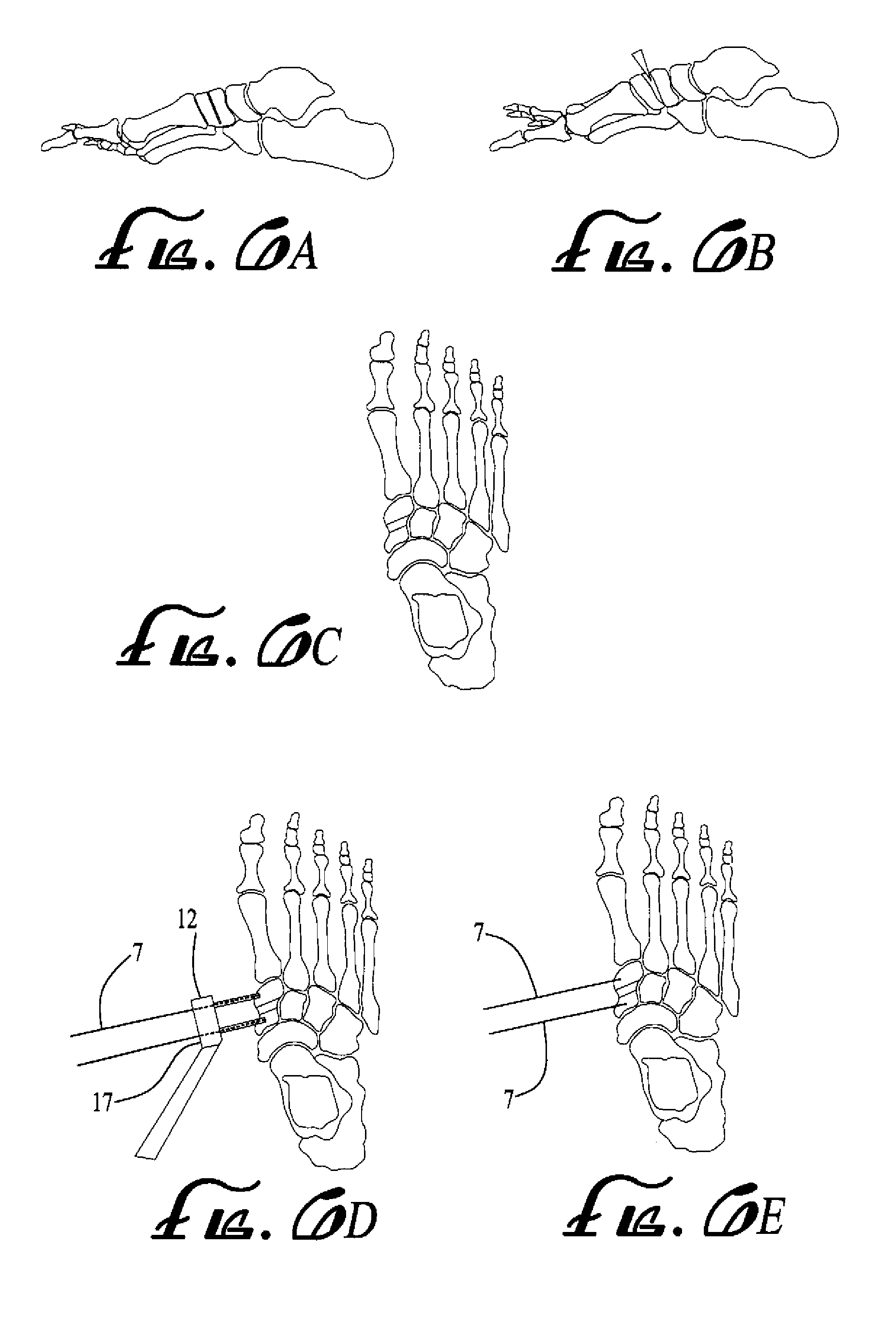 Surgical device, system and method of use thereof