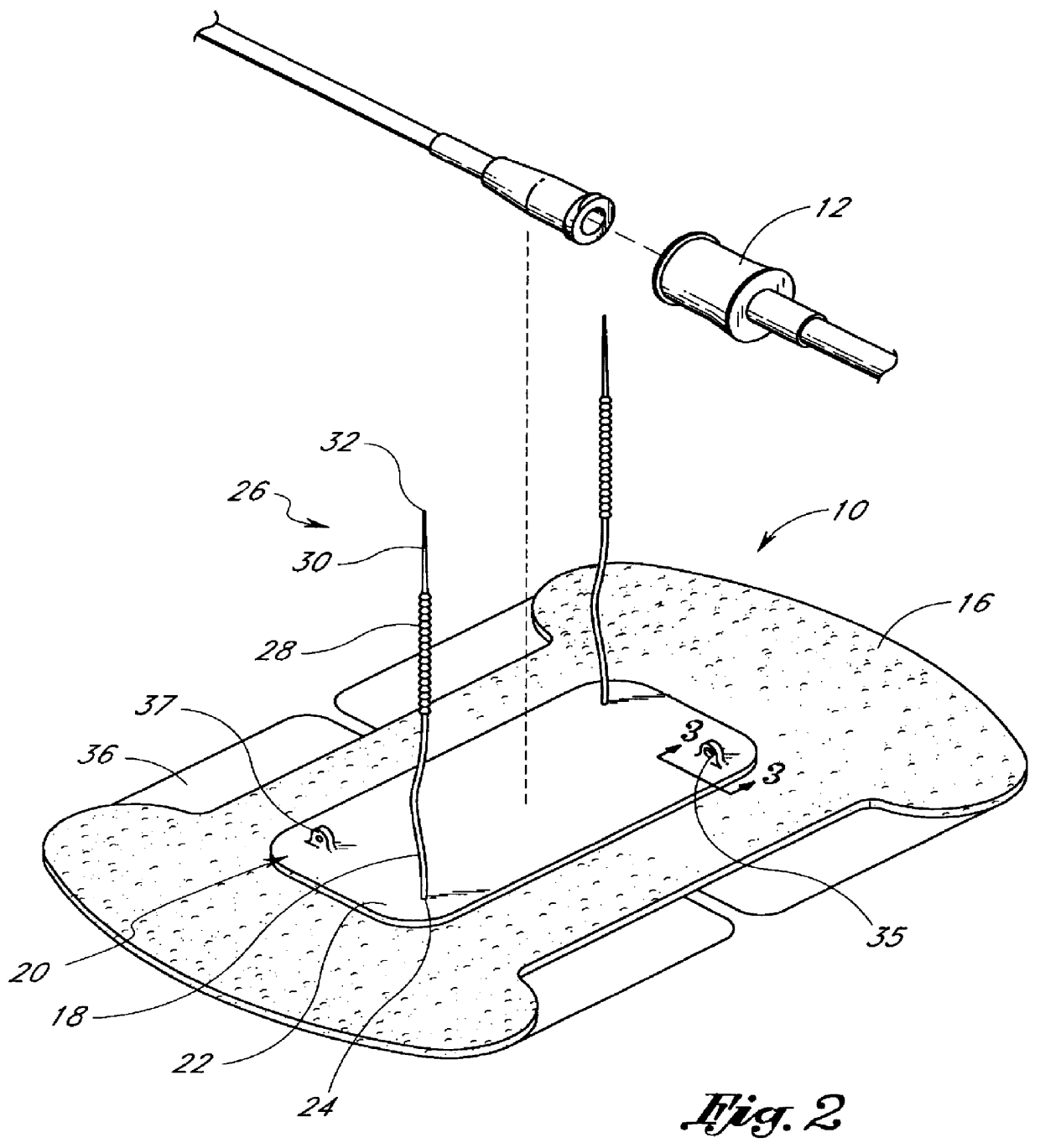 Catheter securement device