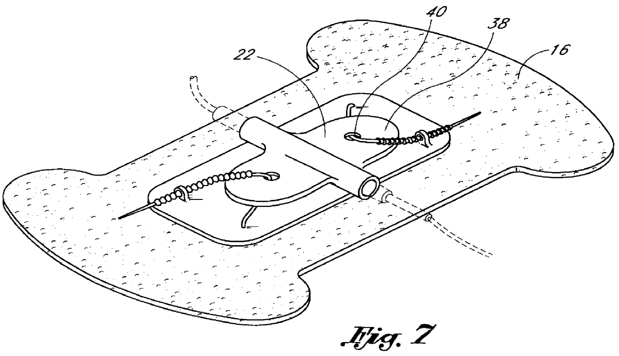 Catheter securement device