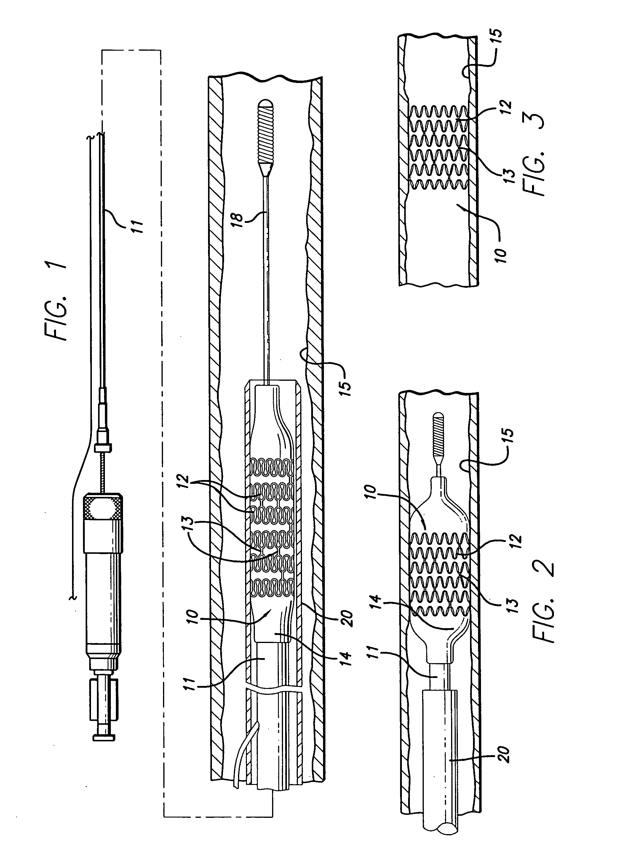 Intravascular stent