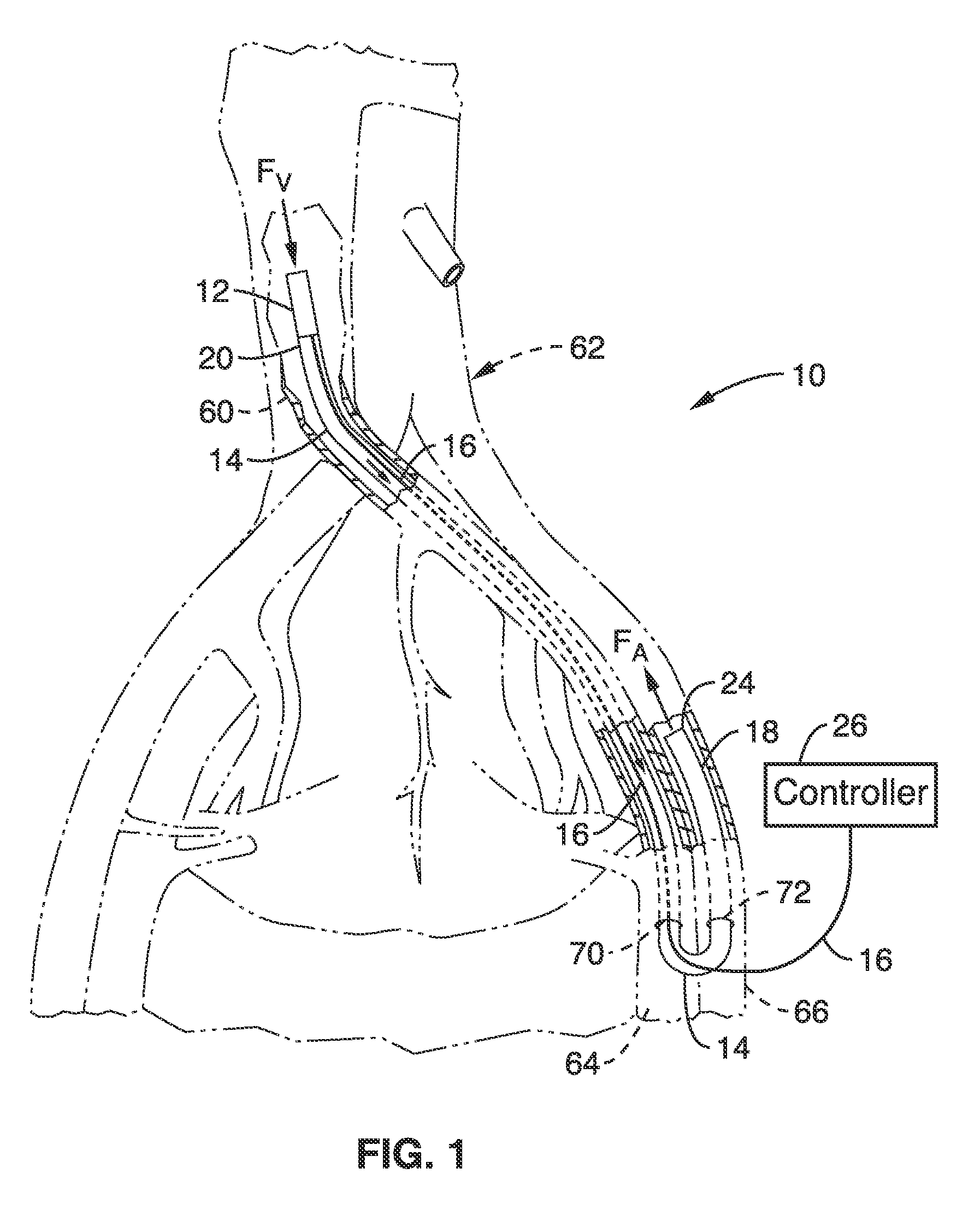 Methods and devices for treating heart failure