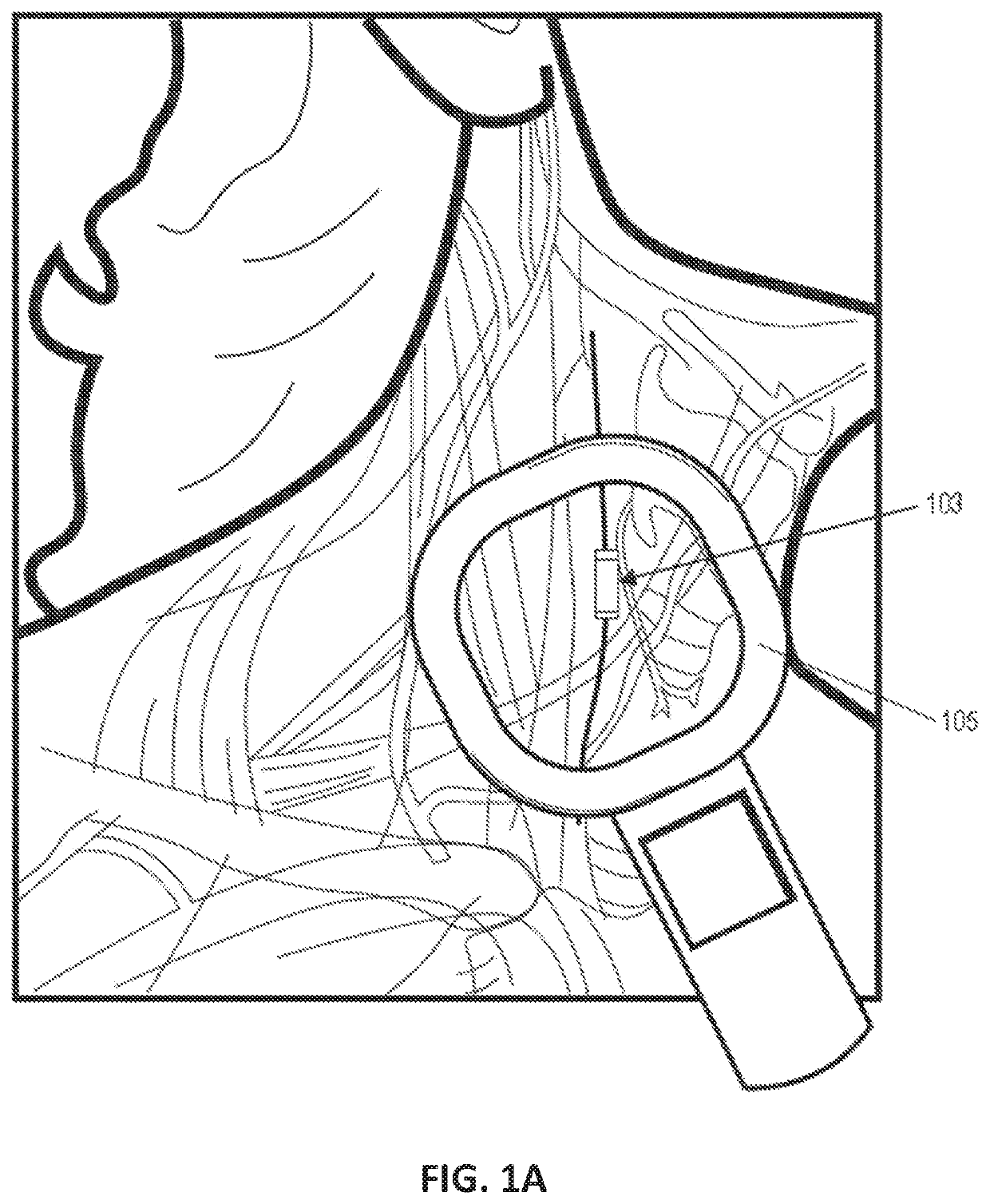 Control of vagal stimulation