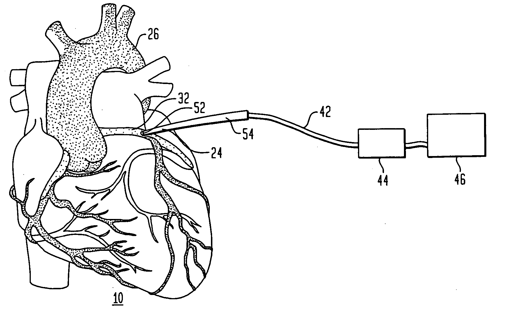 Cardiac ablation using microbubbles