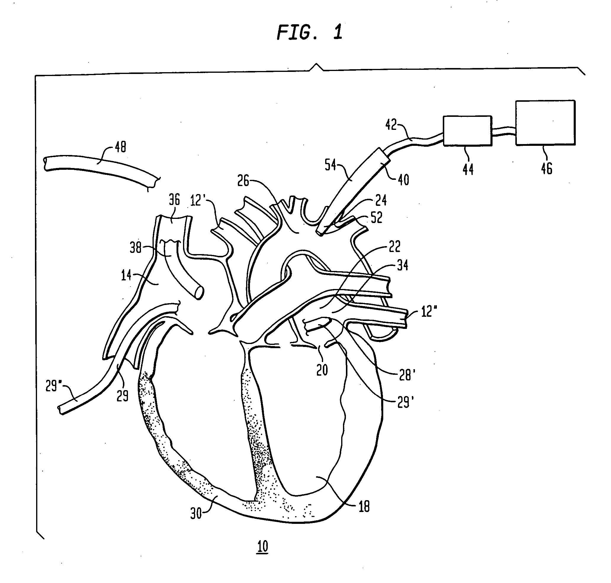 Cardiac ablation using microbubbles