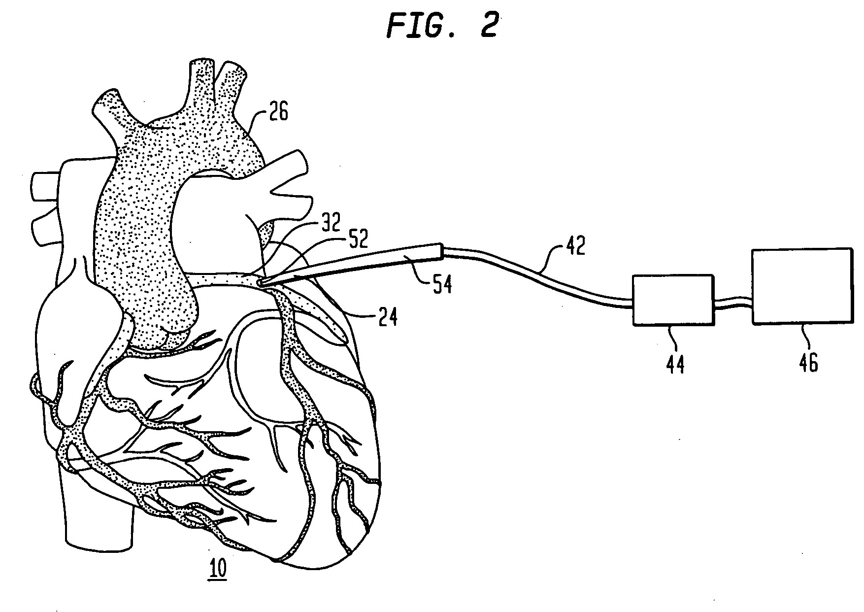 Cardiac ablation using microbubbles