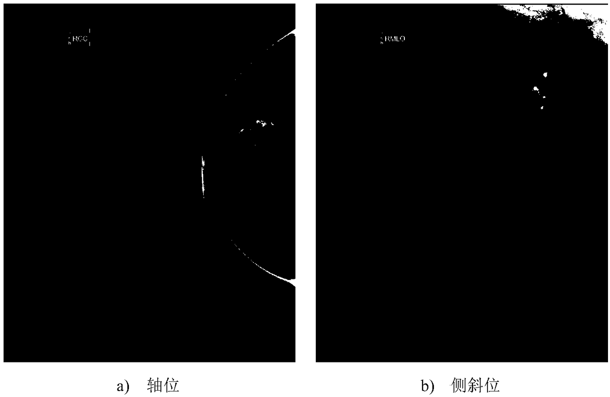 Breast cancer histopathologic grading method based on CNN and image histological feature fusion