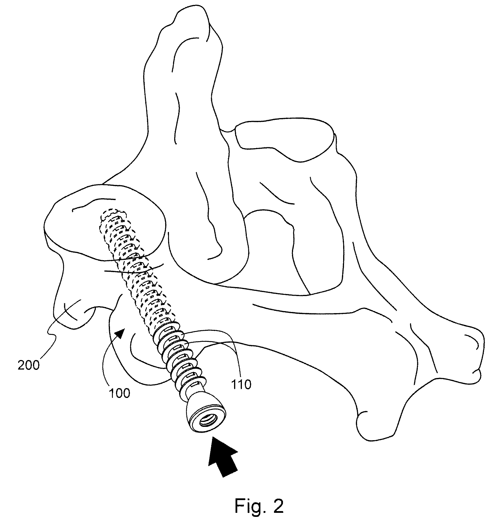 Method and device for delivering medicine to bone