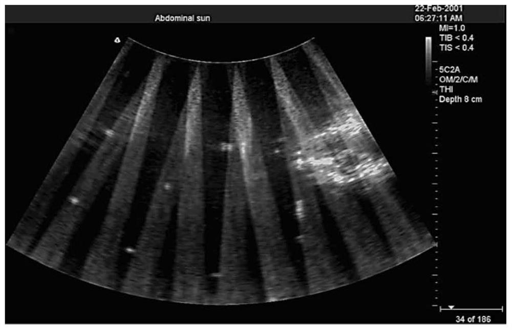 Optimizing Method of Ultrasonic Focus Positioning Image