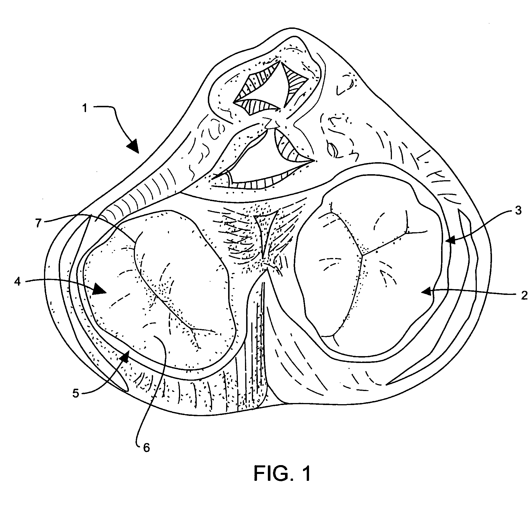 Annuloplasty device having shape-adjusting tension filaments