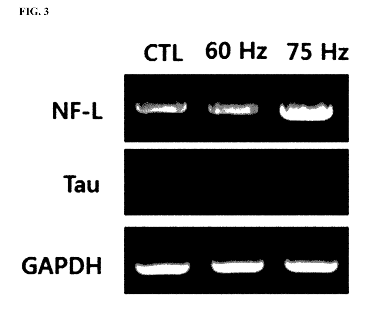 Method of differentiating adult stem cells into nerve cells by using high-intensity electromagnetic field