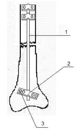 Internal fracture fixator