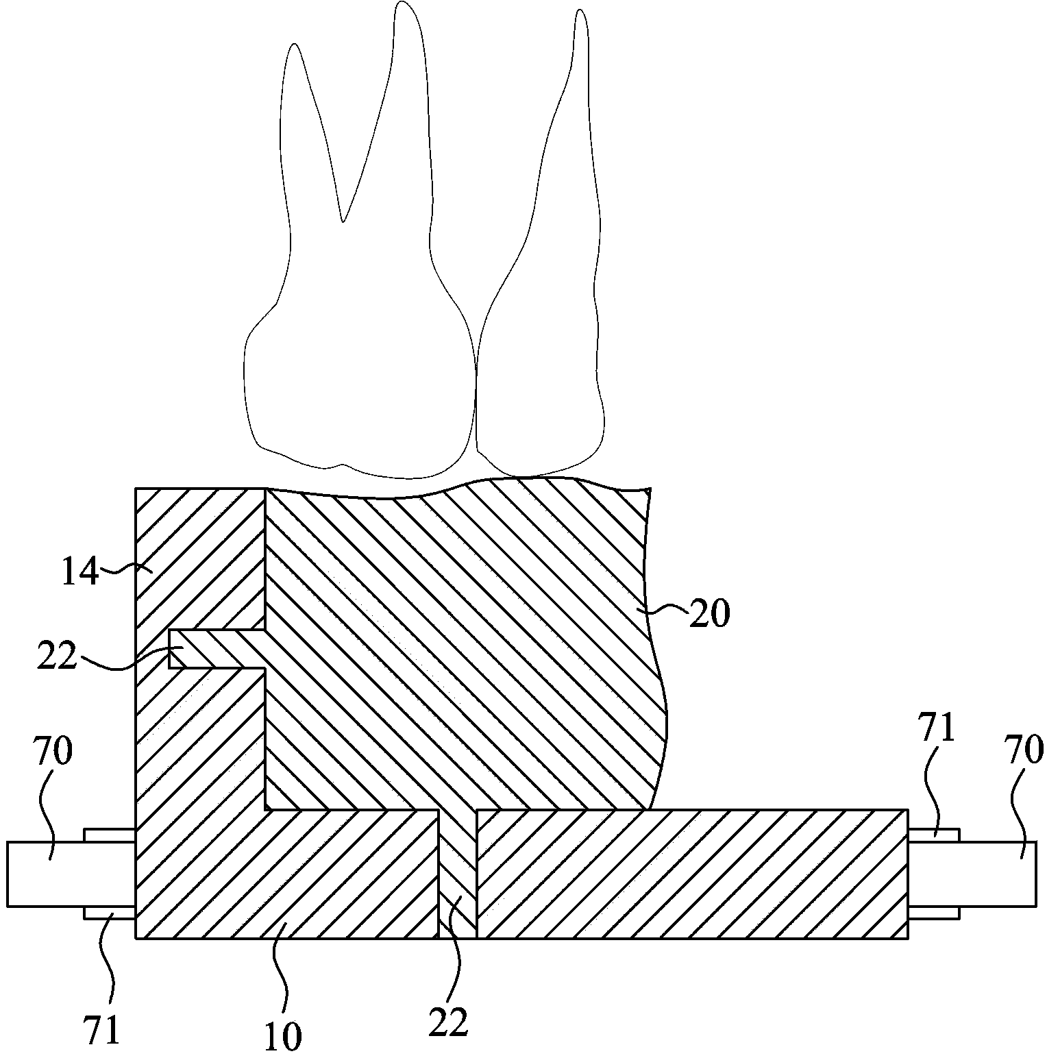 Positioning and measurement device for oral cavity implant correction operation