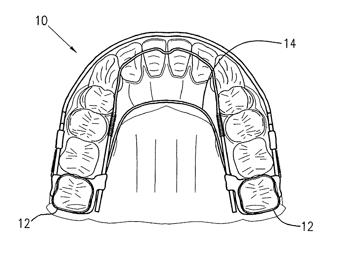 Orthodontic appliance and method