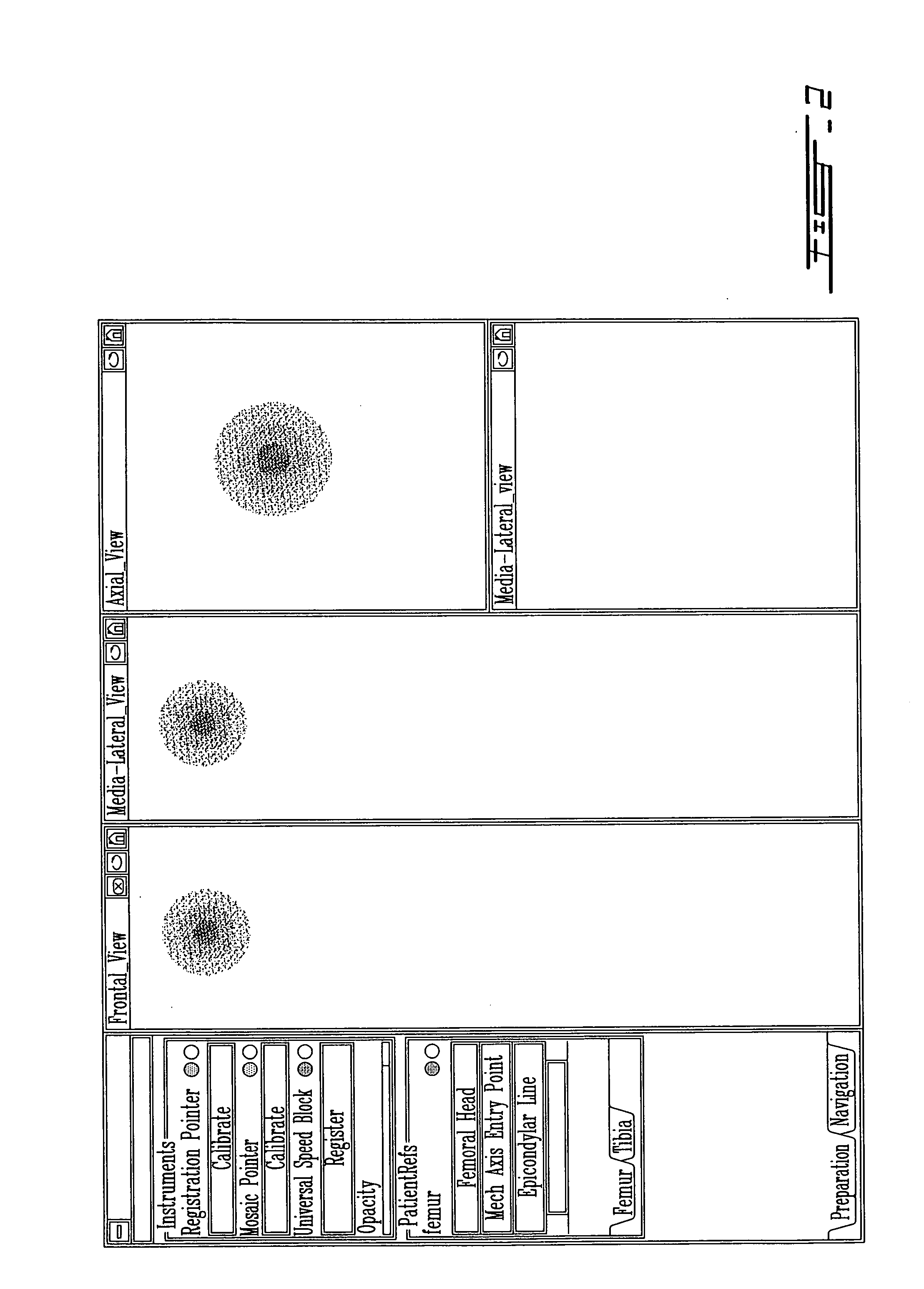 Method for locating the mechanical axis of a femur