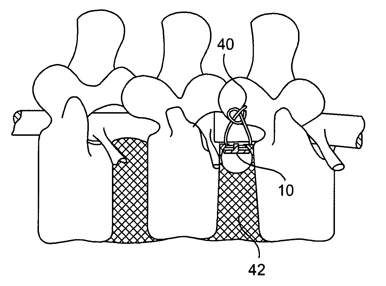 Methods and devices for spinal disc annulus reconstruction and repair