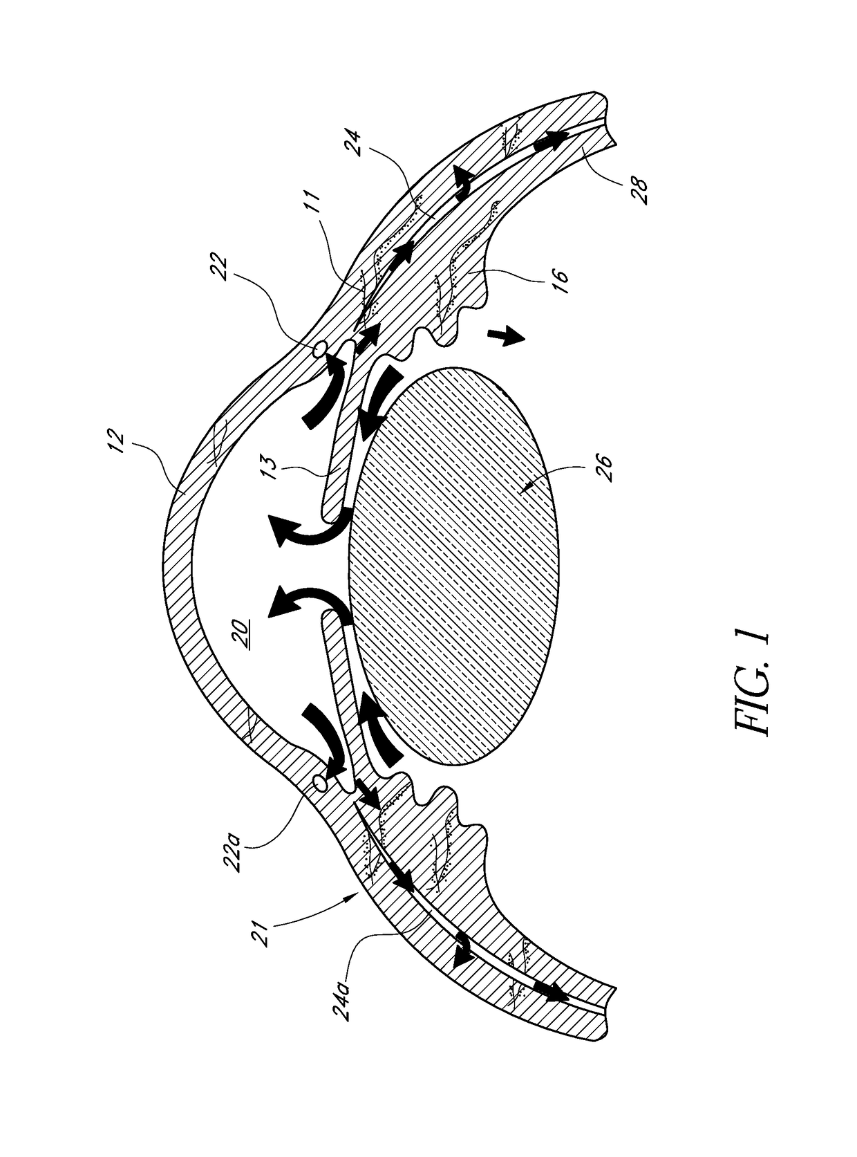 Uveoscleral drug delivery implant and methods for implanting the same