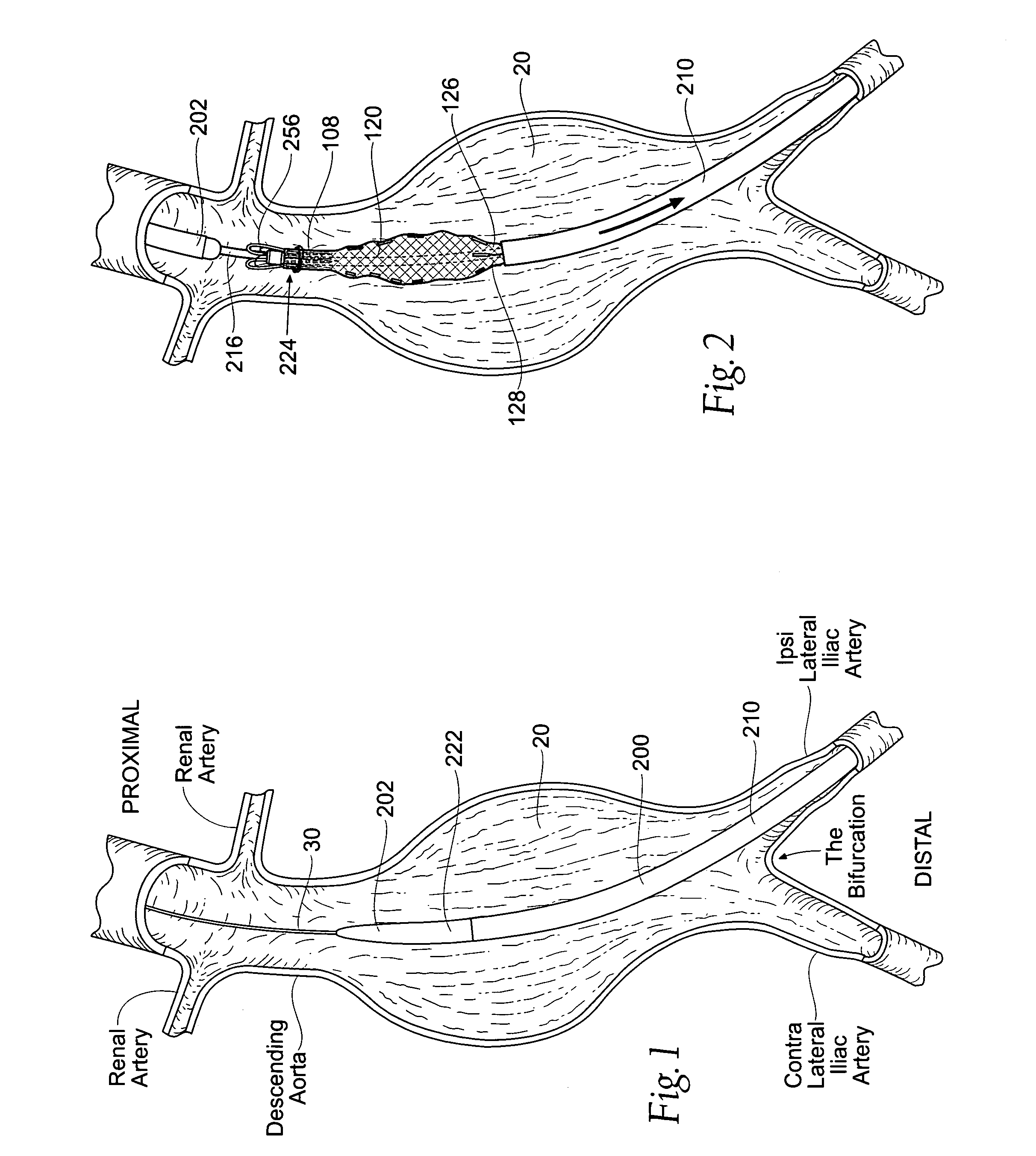 Devices, systems, and methods for prosthesis delivery and implantation