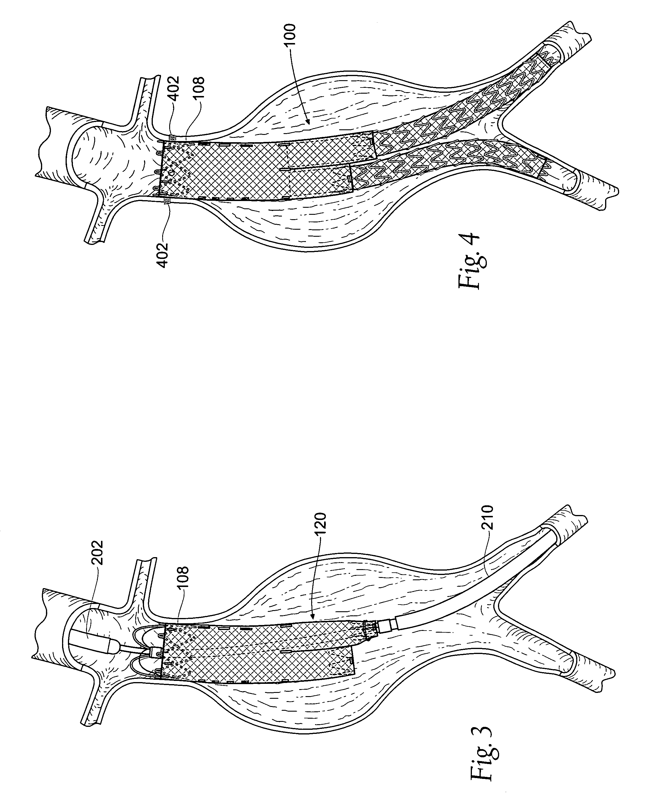 Devices, systems, and methods for prosthesis delivery and implantation