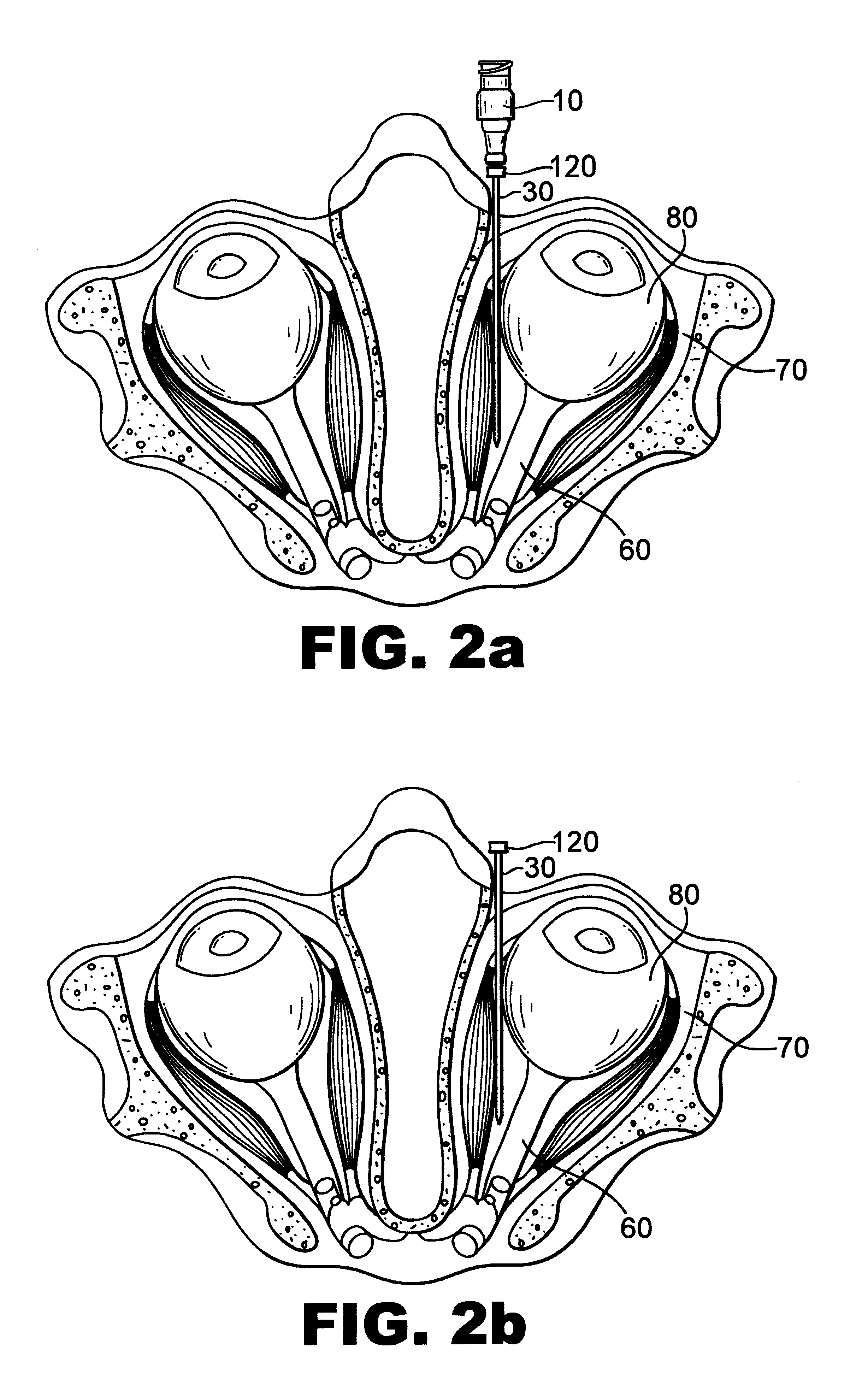 Method and apparatus for treatment of amblyopia