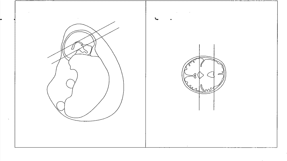 Method for positioning three axial positions of fetal brain through nuclear magnetic resonance