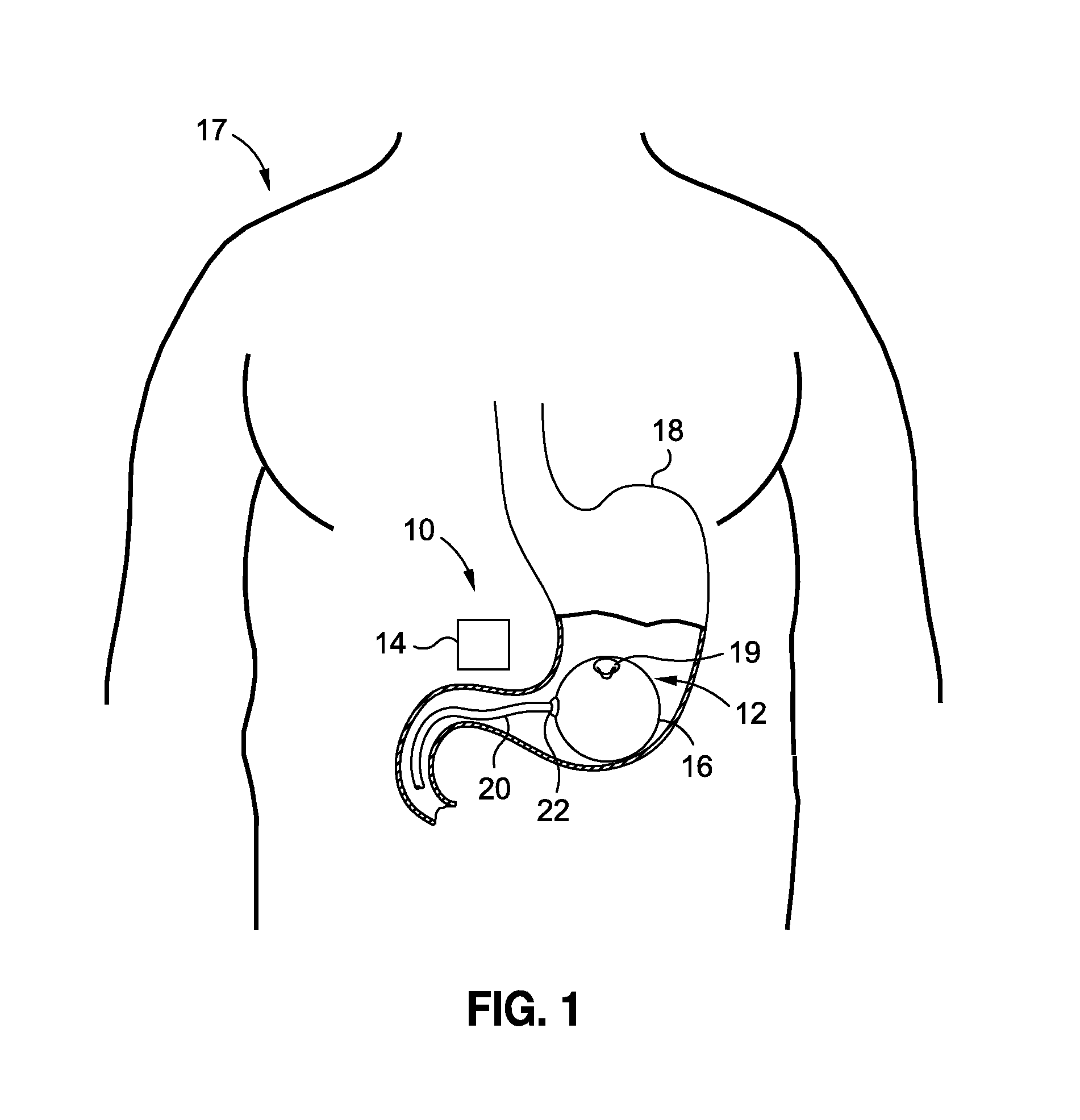 Intragastric Volume Occupying Device with Active Agents