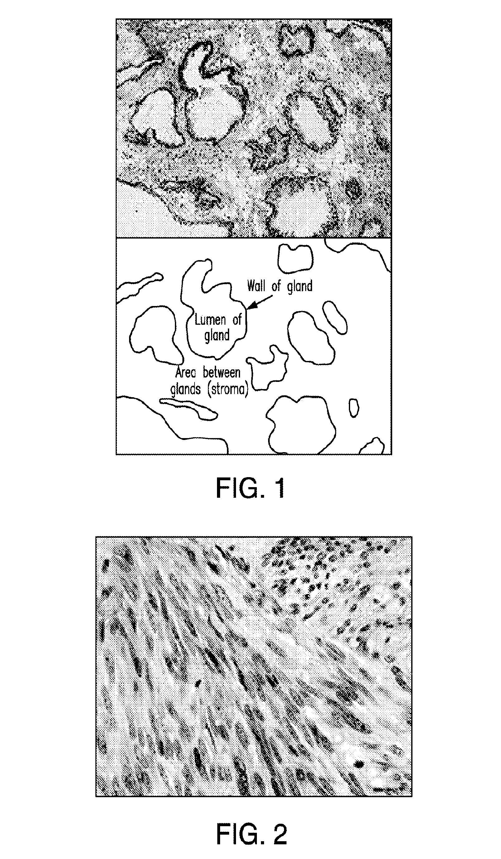 Liposomally encapsulated reduced glutathione for management of cancer, including with other pharmaceutical compositions