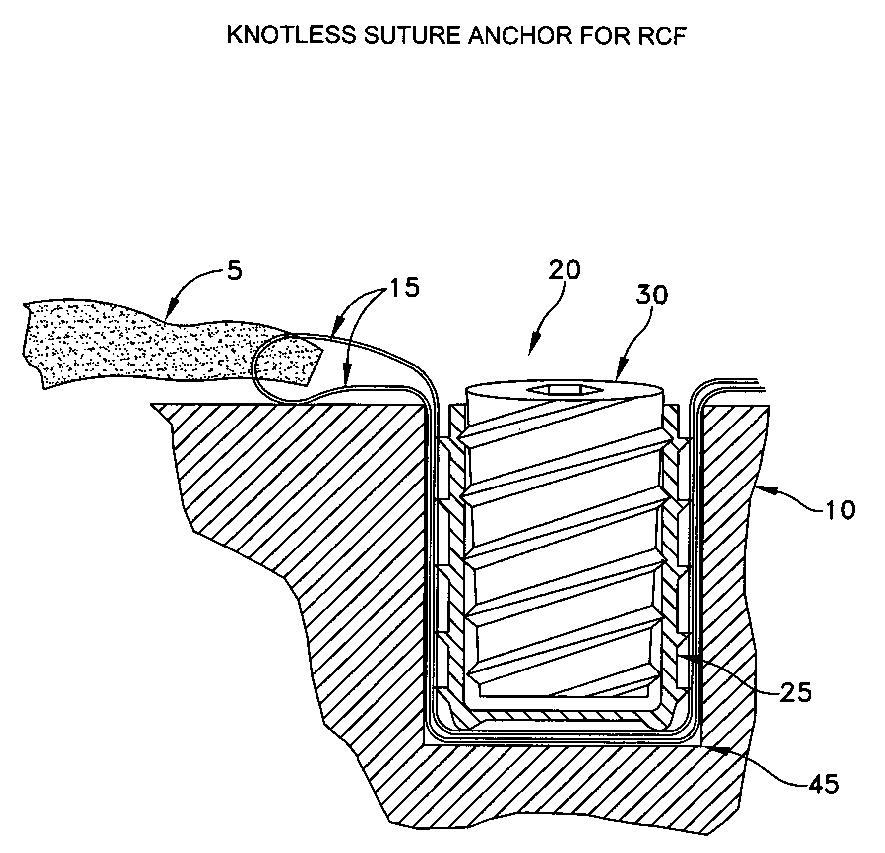 Knotless suture anchor