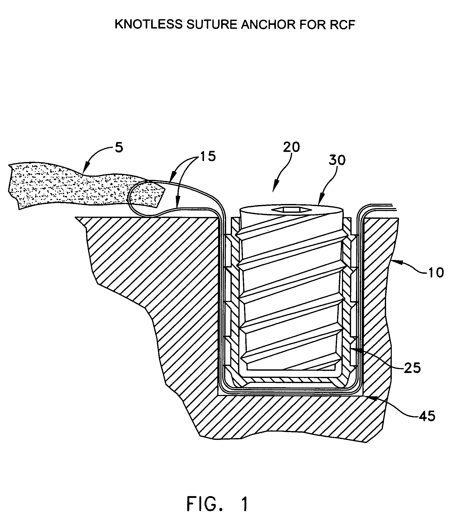 Knotless suture anchor