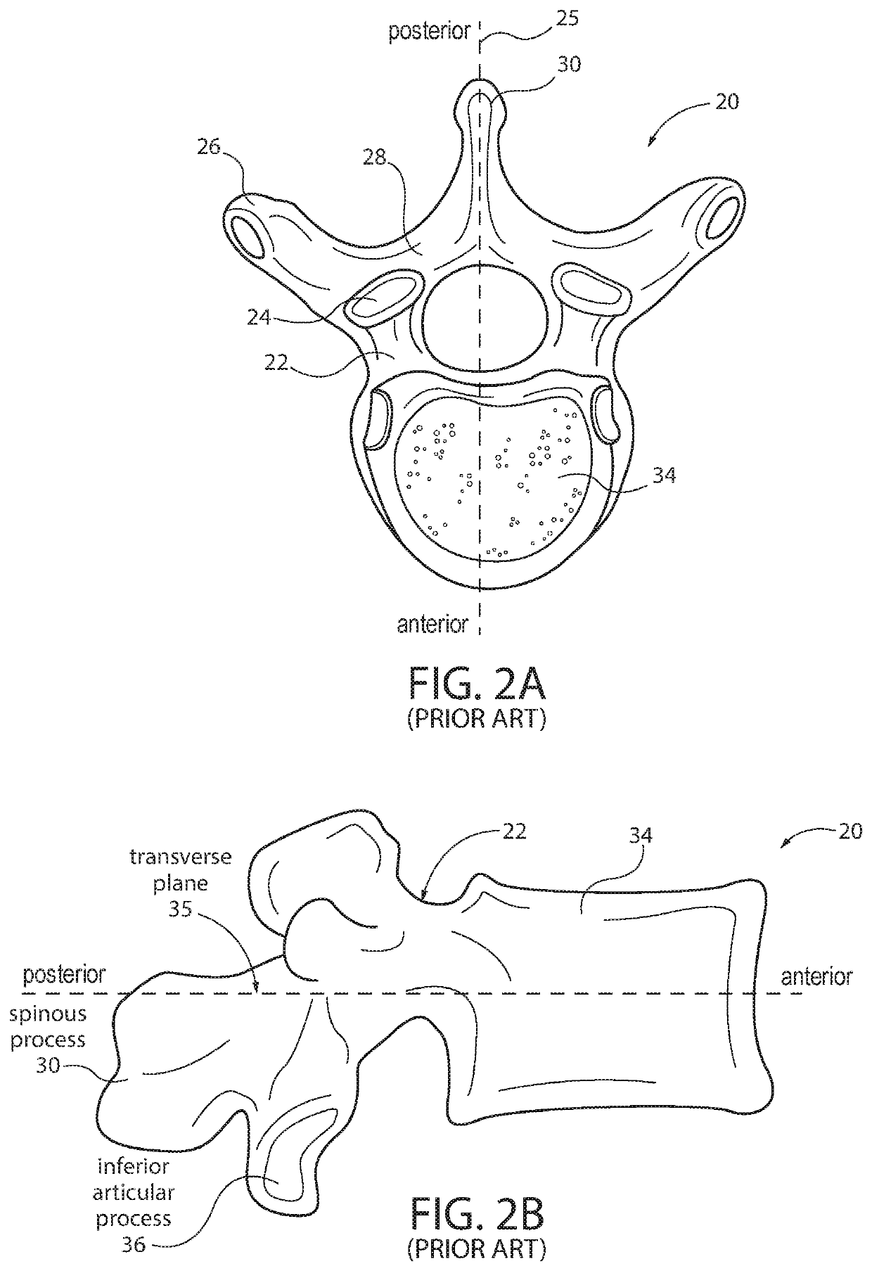 Pedicle screw placement system and method for spinal surgery