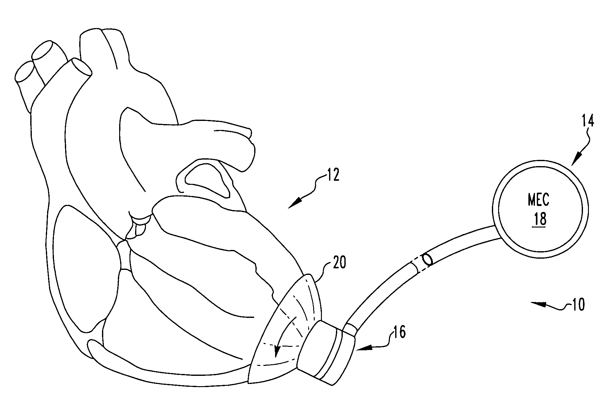 Apical torsion device for cardiac assist