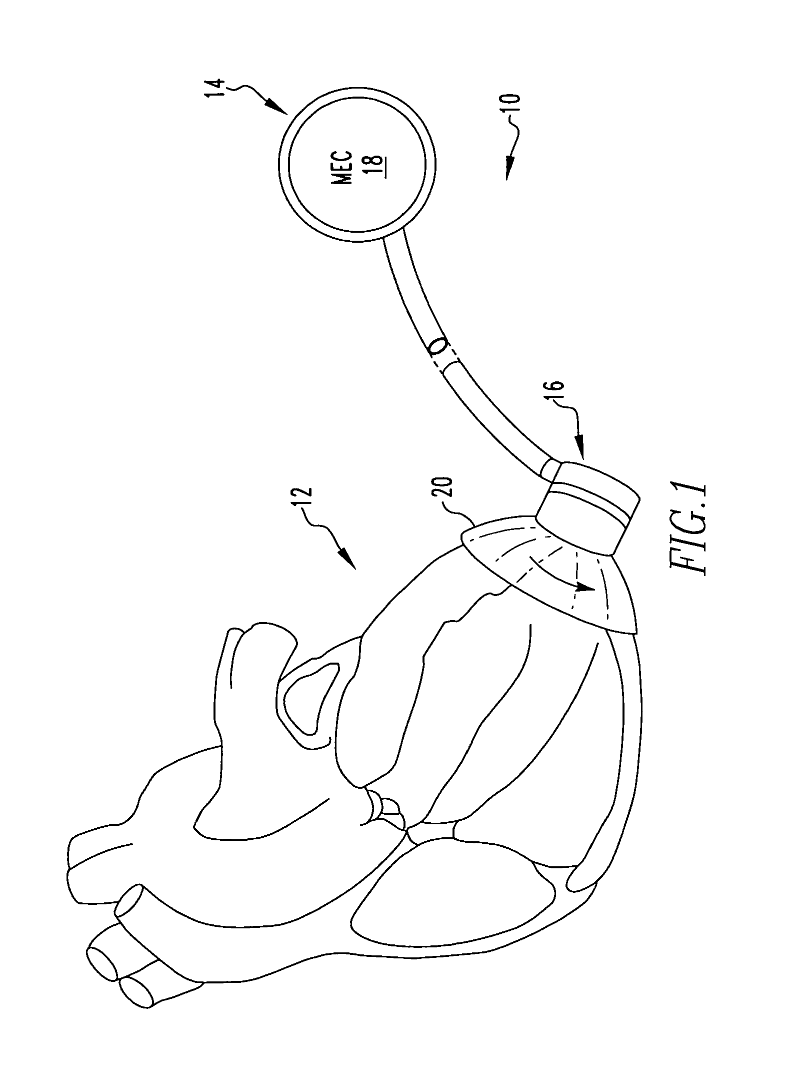 Apical torsion device for cardiac assist