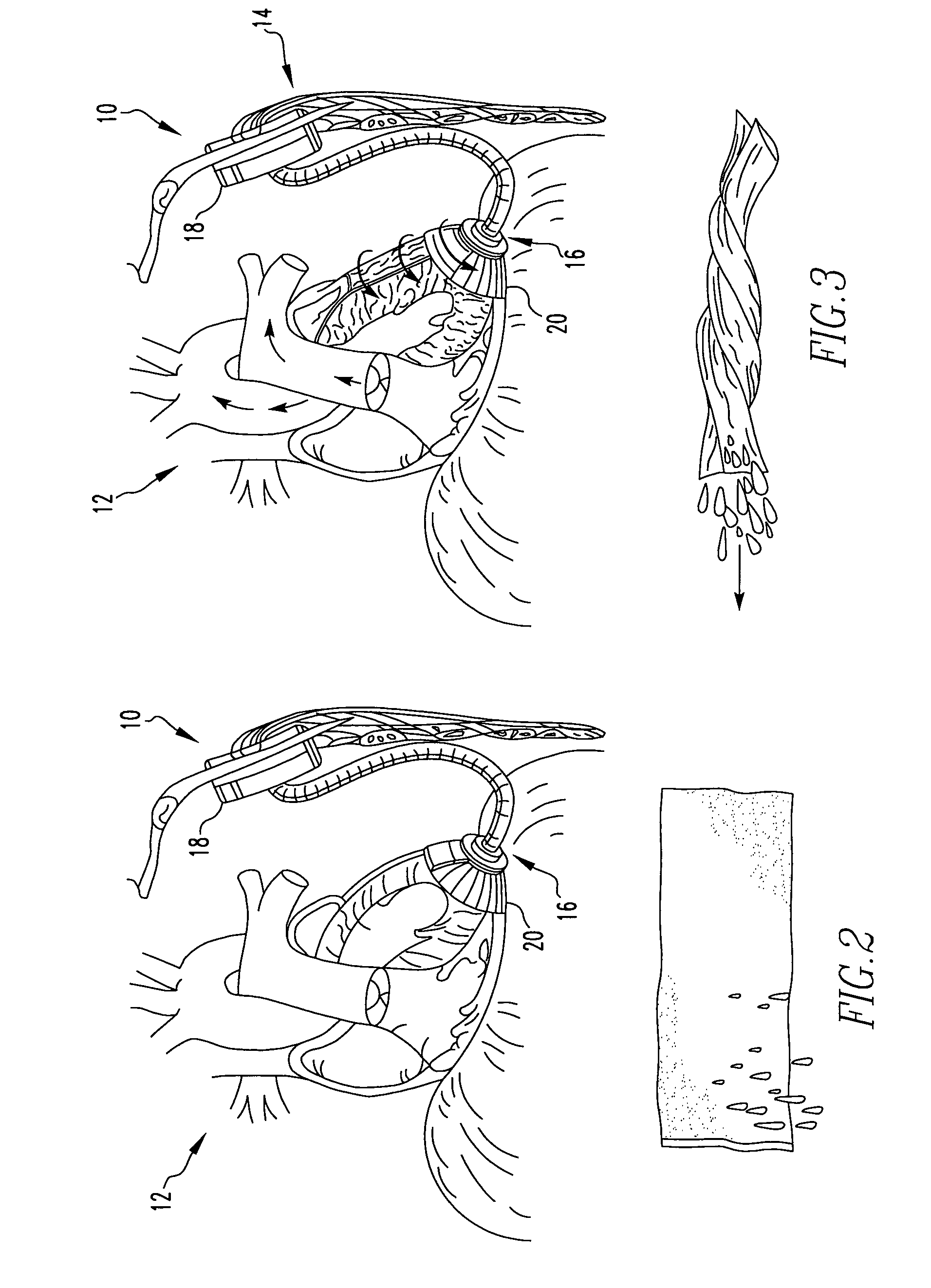 Apical torsion device for cardiac assist