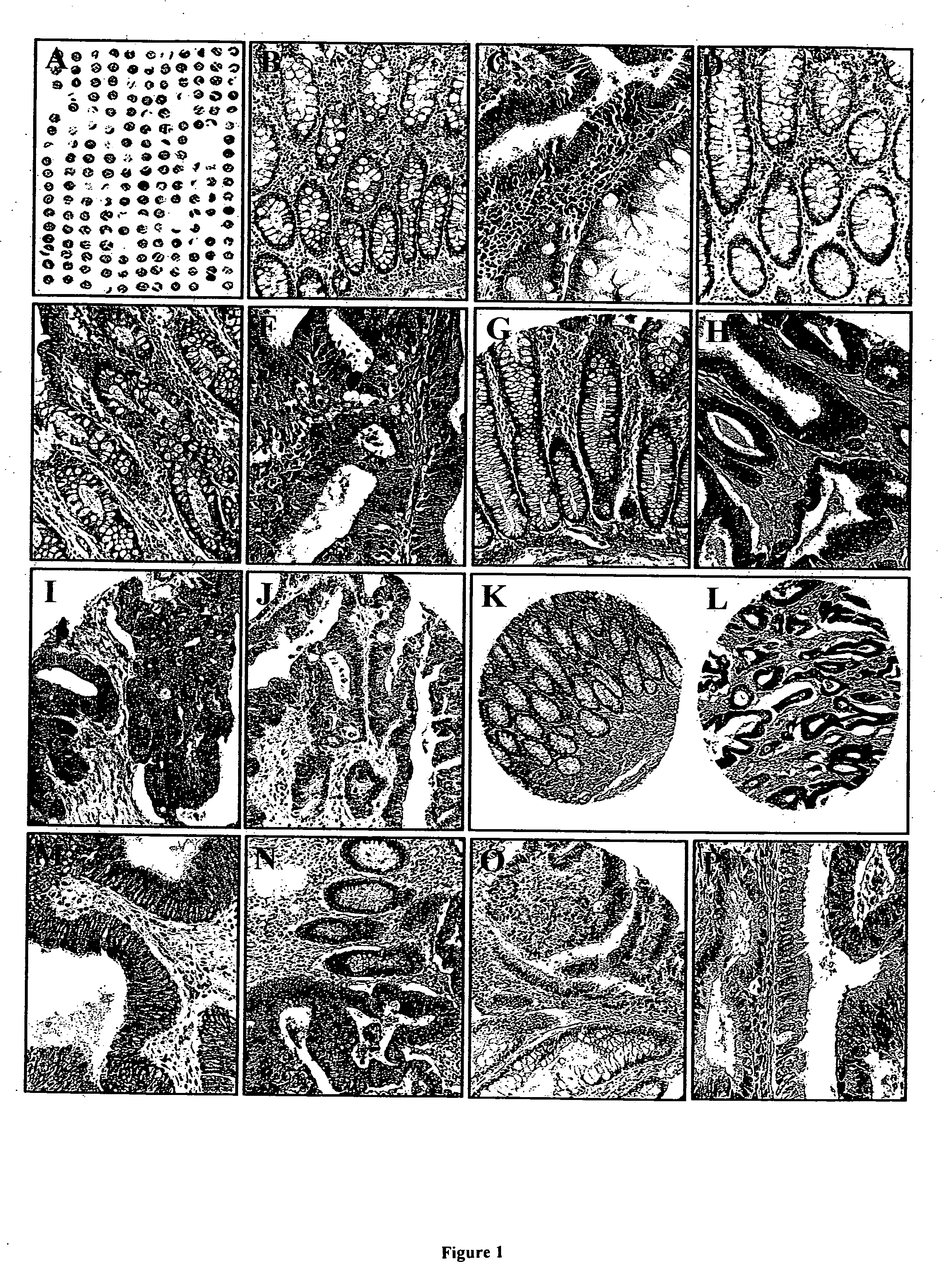 Methods for determining the prognosis for cancer patients using TUCAN