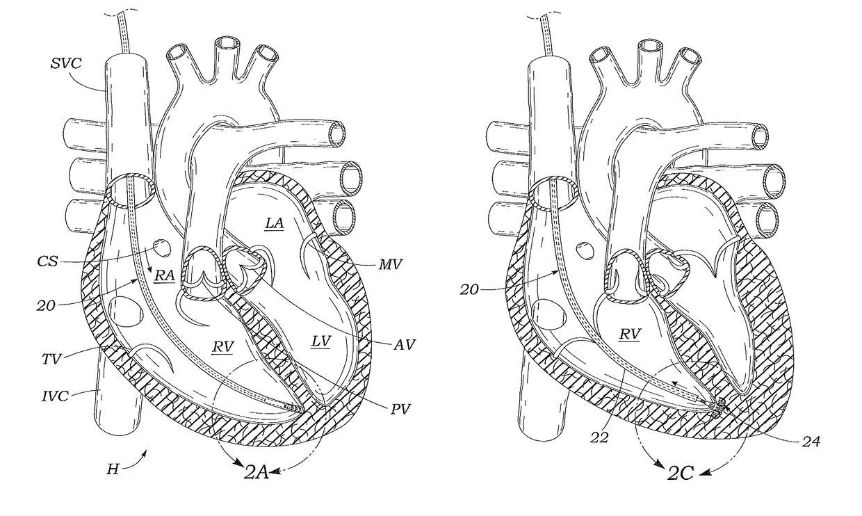 Systems and methods for placing a coapting member between valvular leaflets