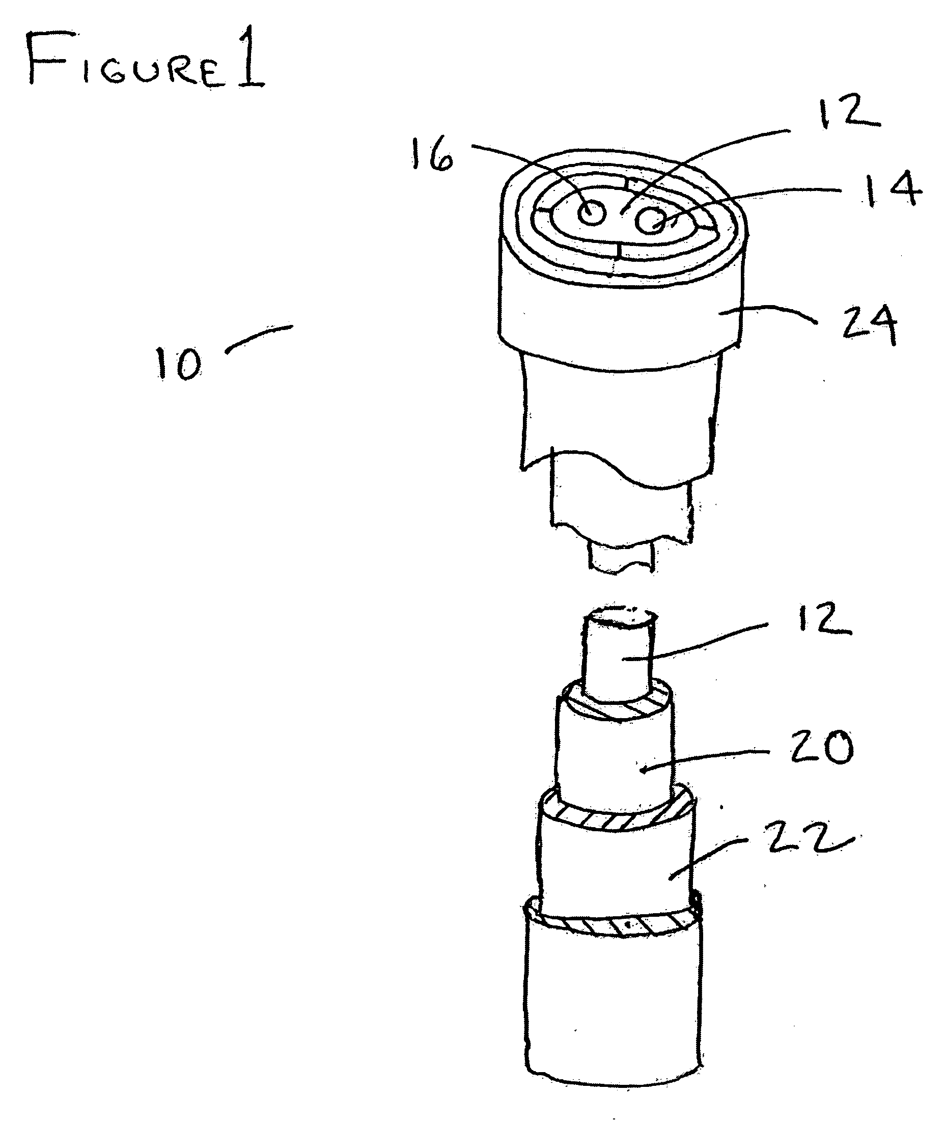 Apparatus and method for stone capture and removal