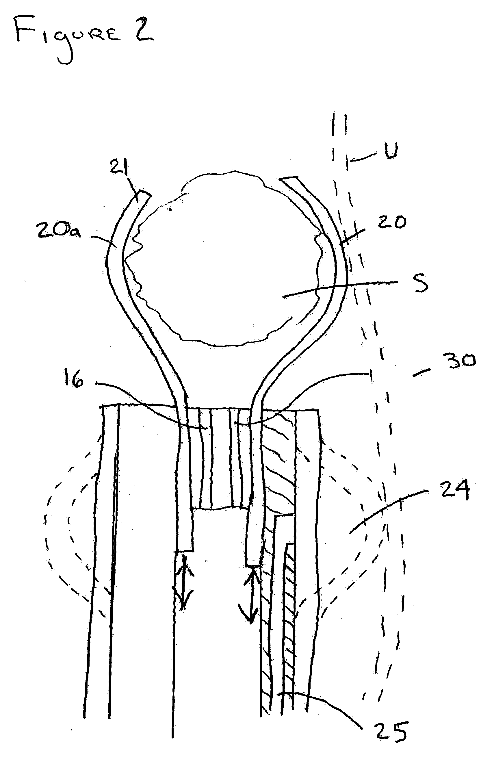 Apparatus and method for stone capture and removal