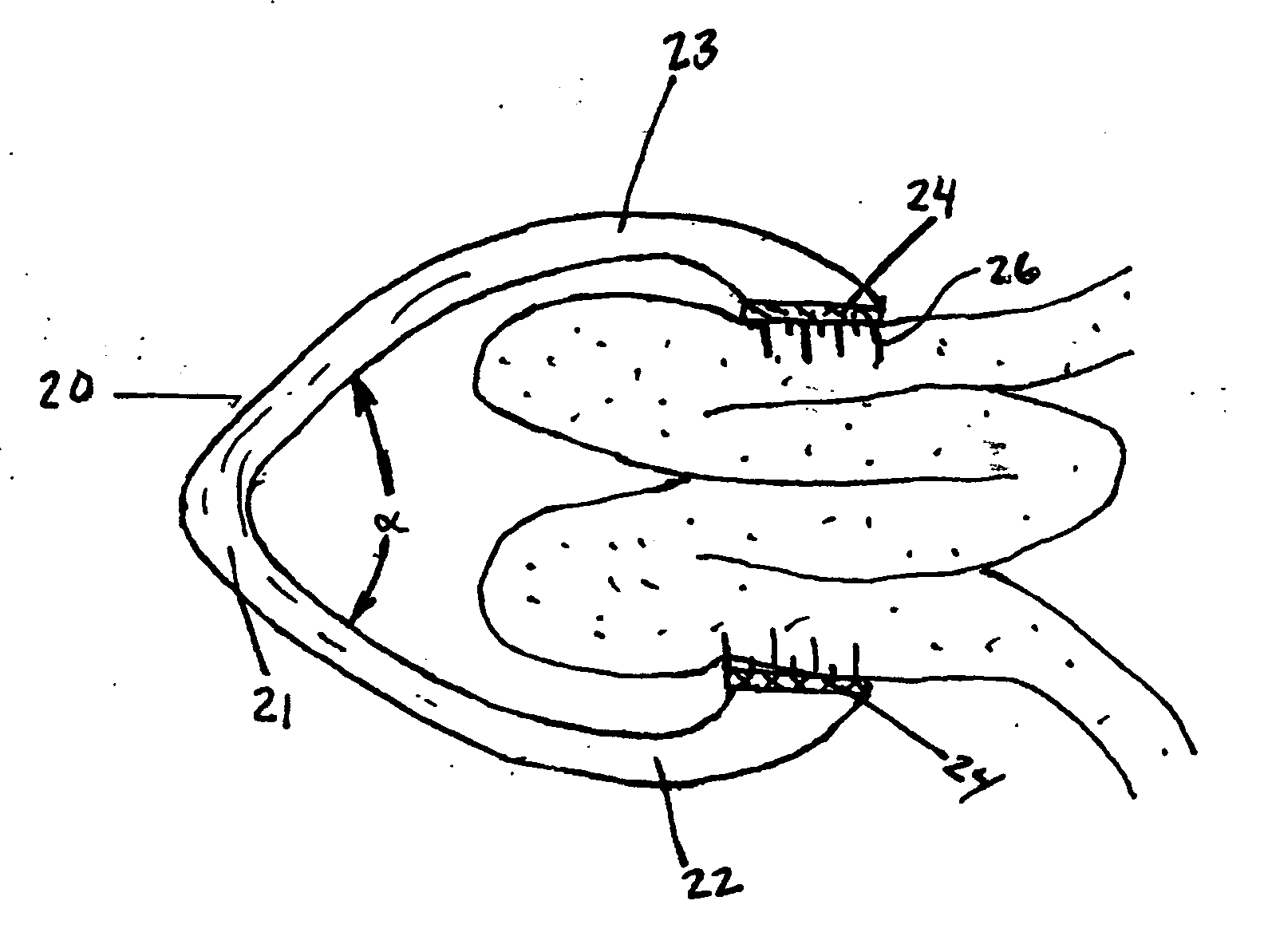 Methods and apparatus for excising tissue and creating wall-to-wall adhesions from within an organ