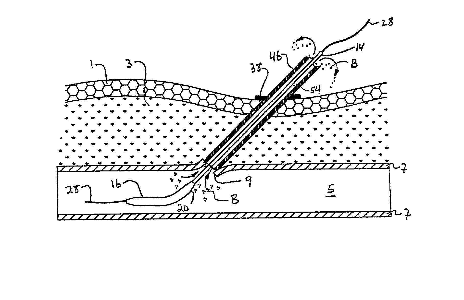 Depth and puncture control for blood vessel hemostasis system