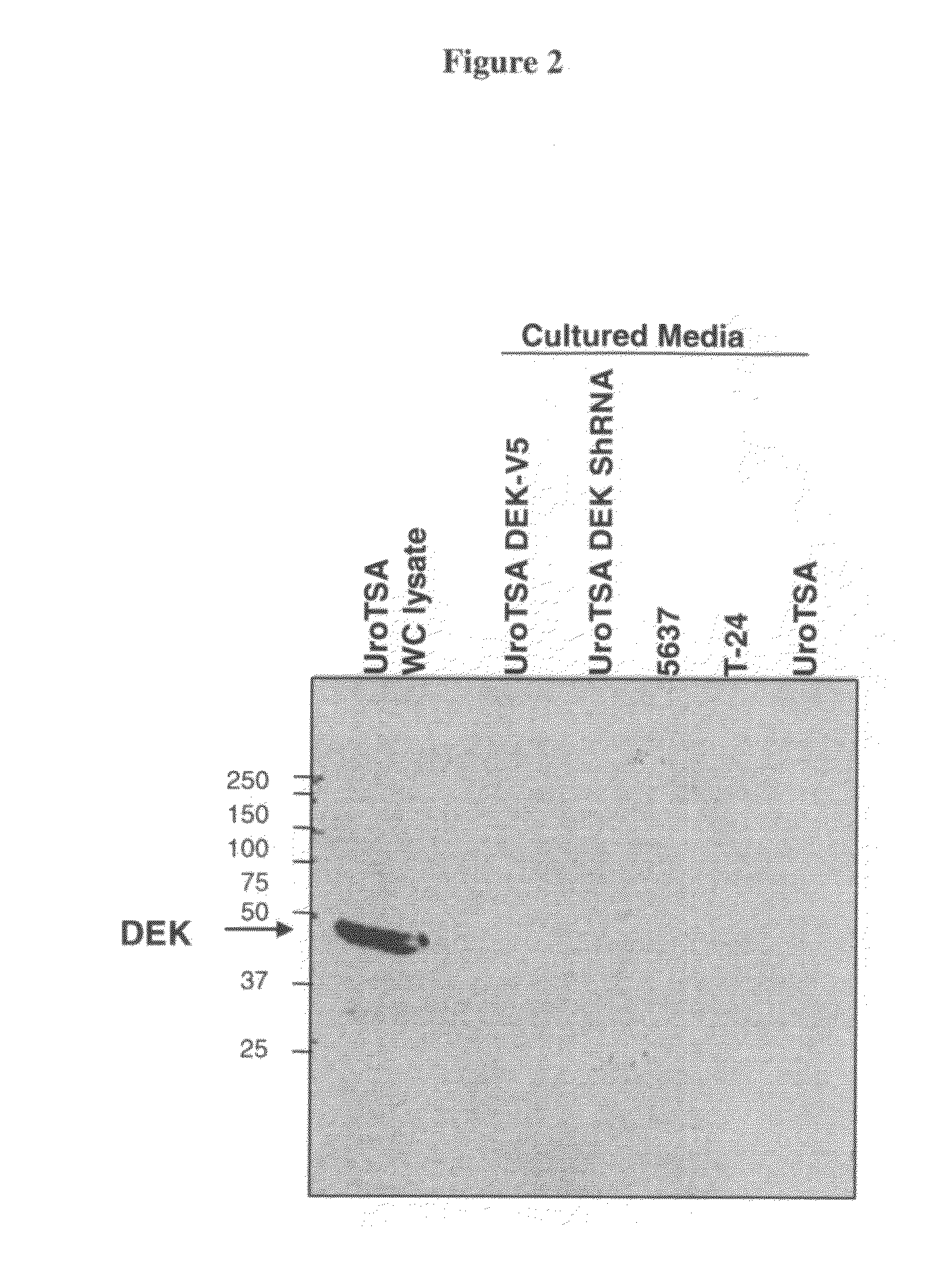 DEK as a urine based biomarker for bladder cancer