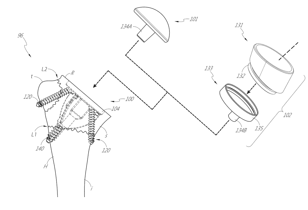 Stemless shoulder implant with fixation components