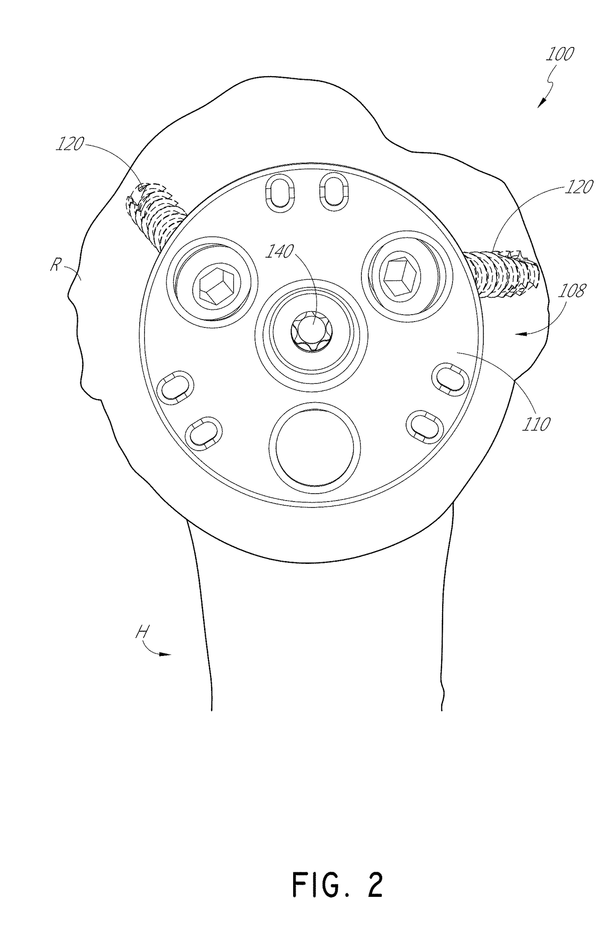 Stemless shoulder implant with fixation components