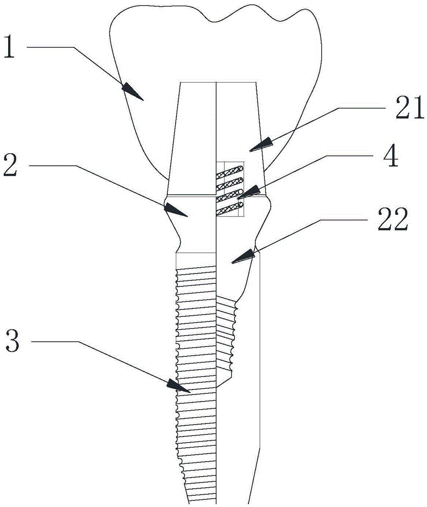 Integrated oral cavity implanting base with buffered and physiological sensation