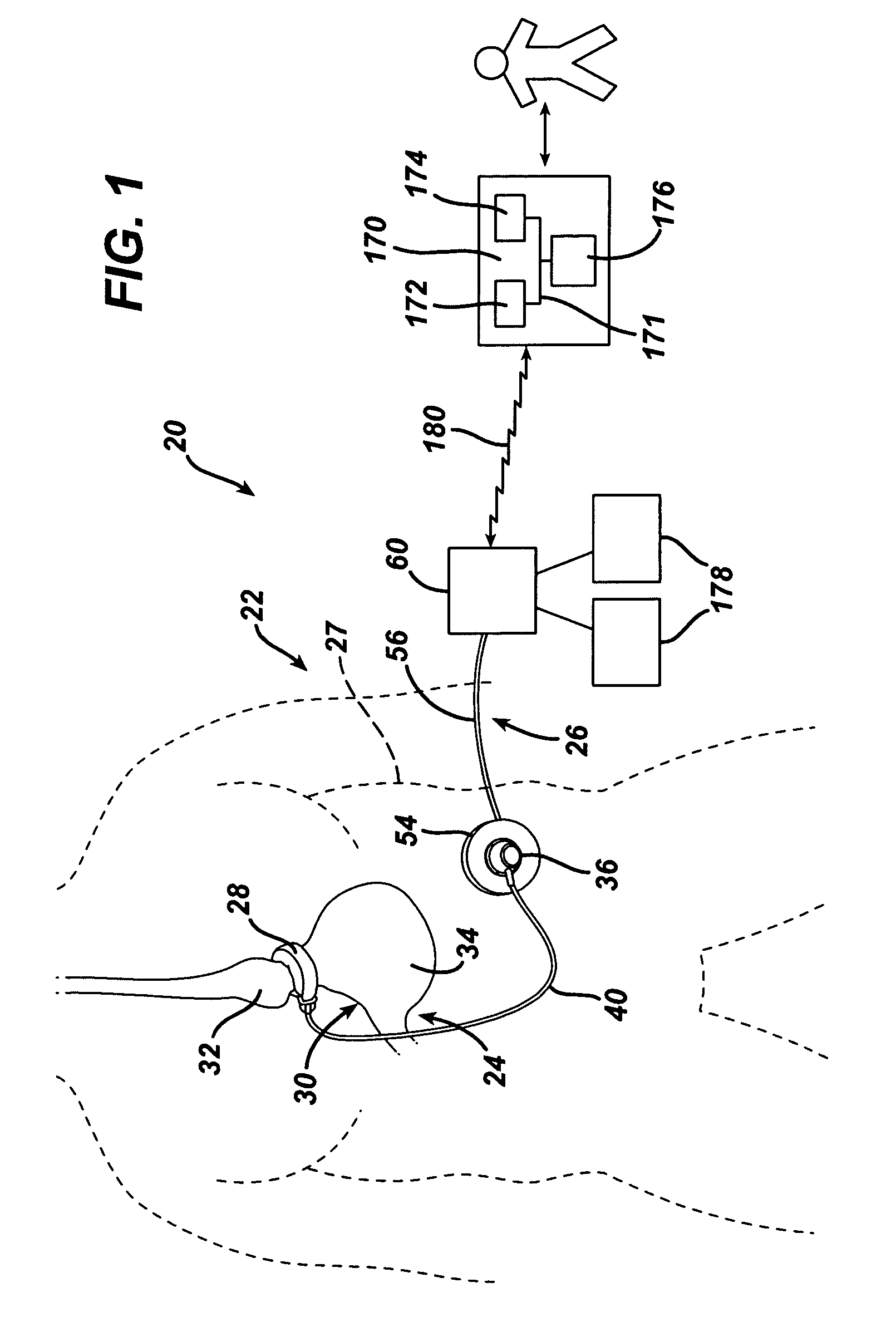 Gui With Trend Analysis for an Implantable Restriction Device and a Data Logger