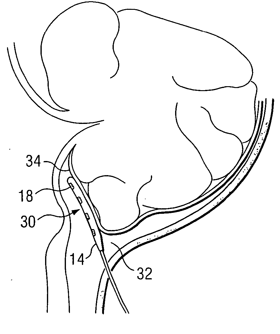 System and method for stimulation of a person's brain stem