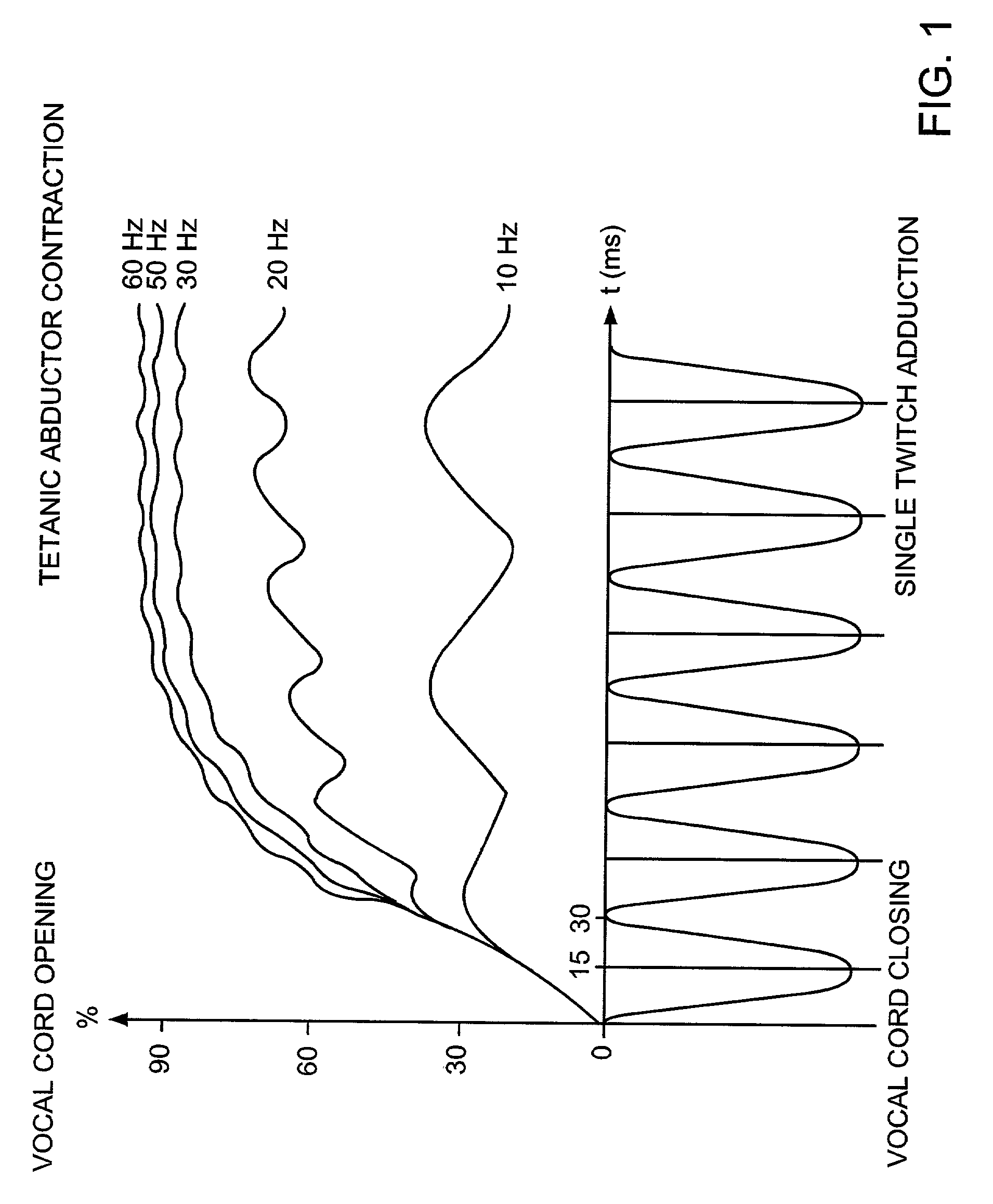 Pacemaker for bilateral vocal cord autoparalysis