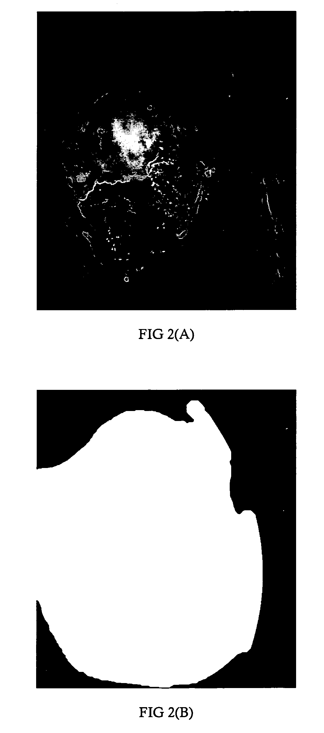 Computerized image analysis for acetic acid induced Cervical Intraepithelial Neoplasia