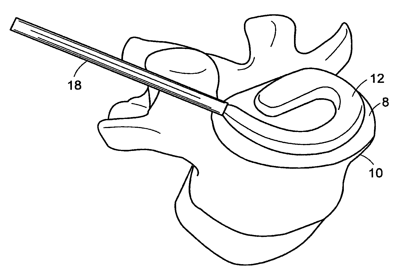 In-situ intervertebral fusion device and method