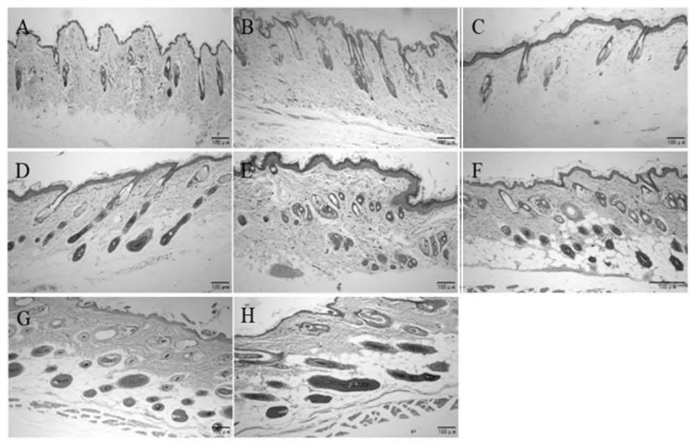 Compound external preparation for treating alopecia areata and preparation method thereof