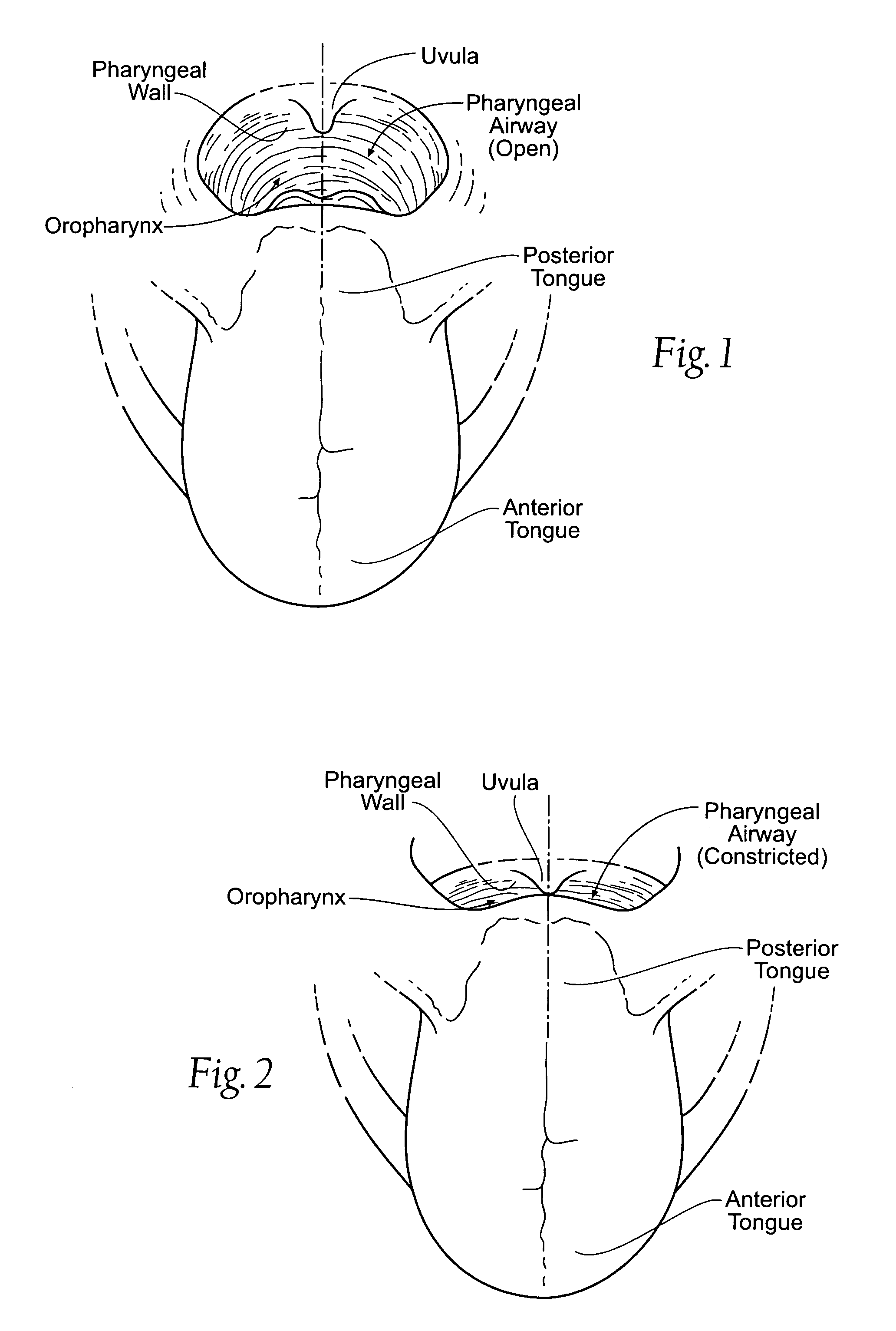 Self-anchoring magnetic force implant devices, systems, and methods