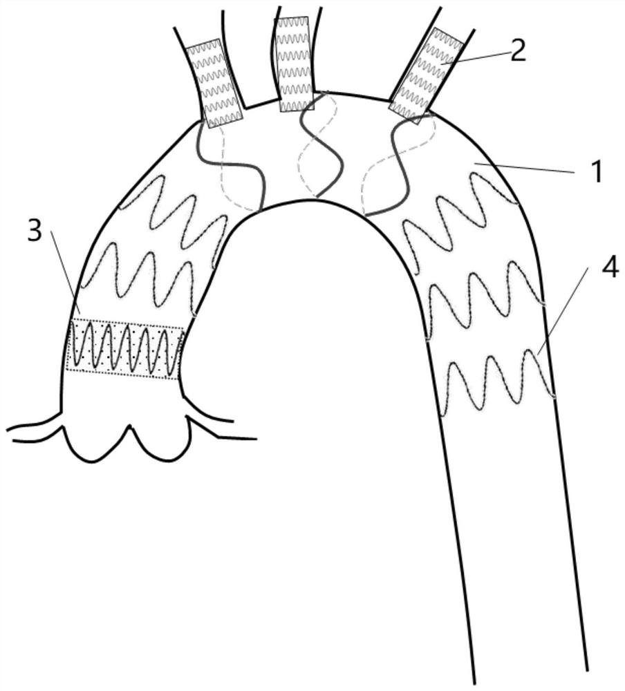 Special covered stent for functional aortic arch in-situ fenestration